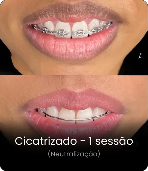 Resultado cicatrizado — neutralização