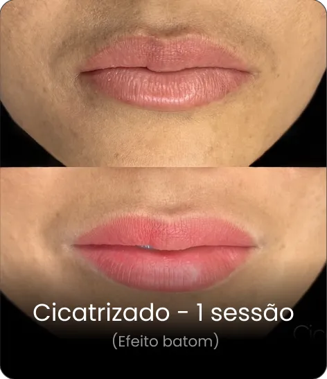 Resultado cicatrizado — neutralização
