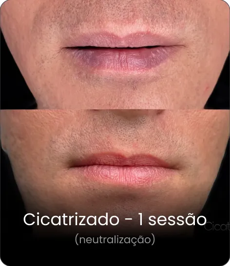 Resultado cicatrizado — neutralização