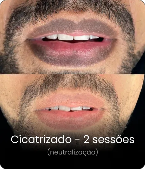 Resultado cicatrizado — neutralização