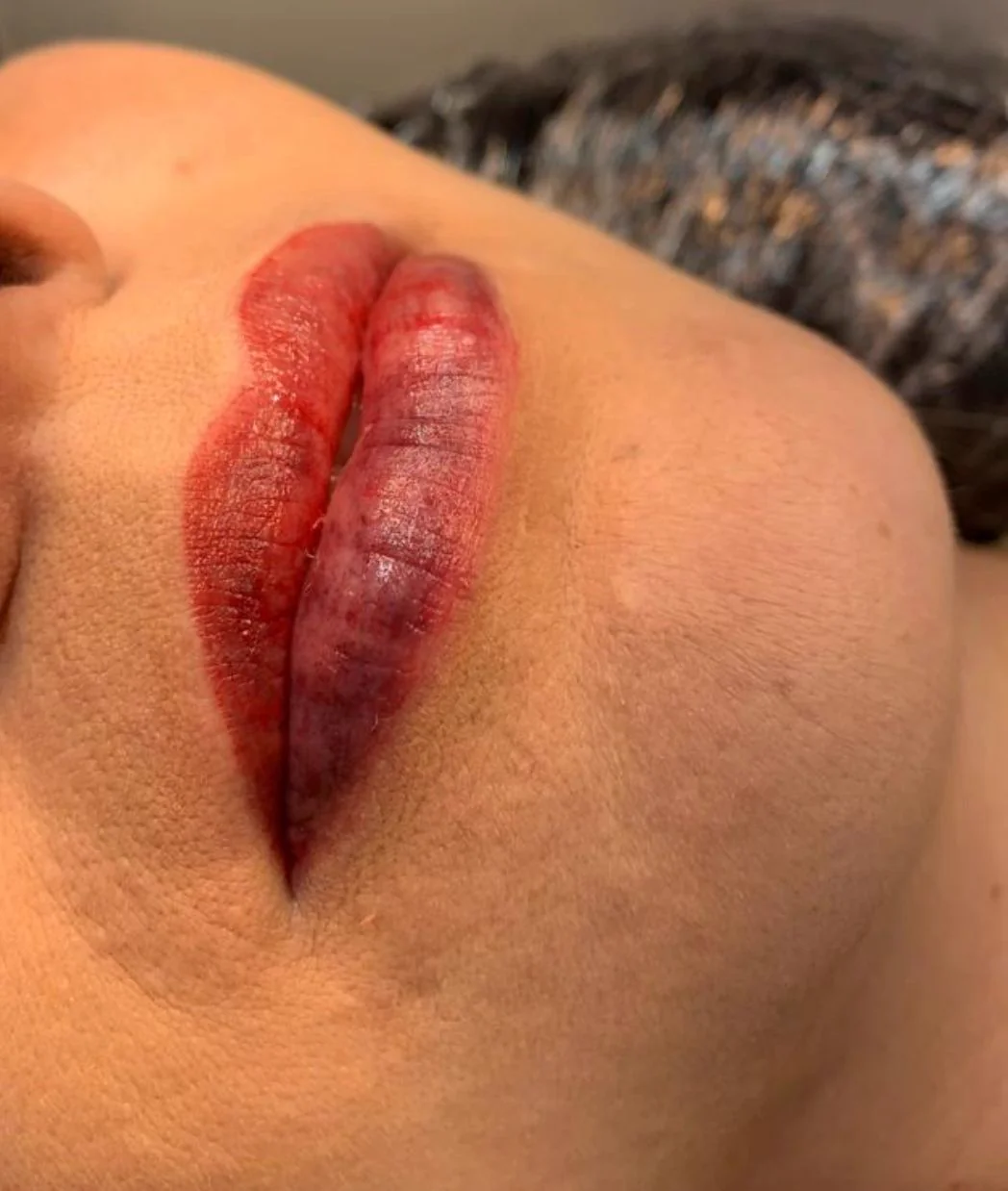 Intercorrência em micropigmentação labial — caso 1