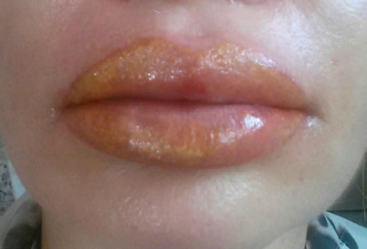 Intercorrência em micropigmentação labial — caso 2