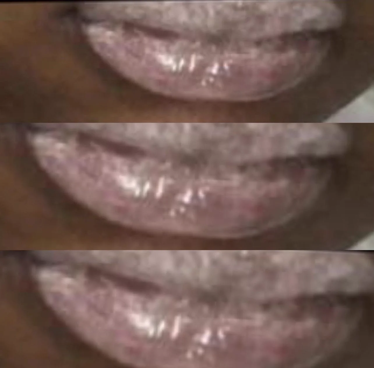 Intercorrência em micropigmentação labial — caso 3