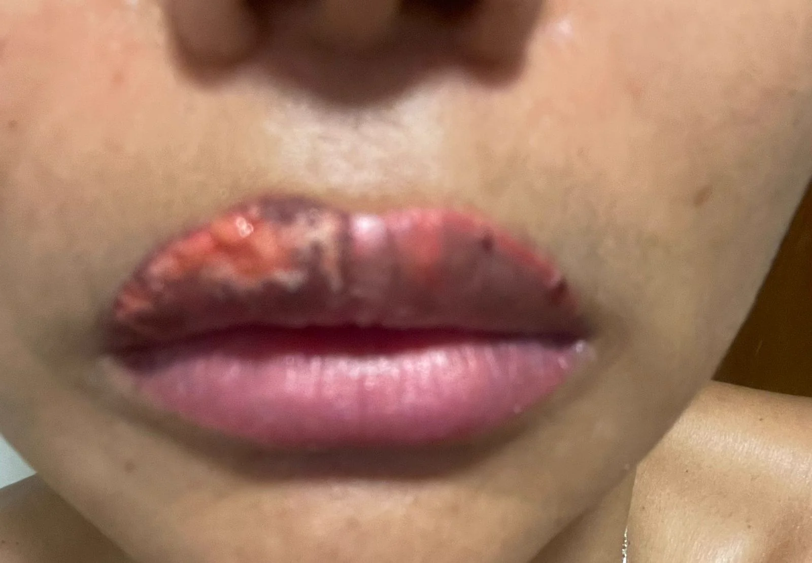 Intercorrência em micropigmentação labial — caso 4