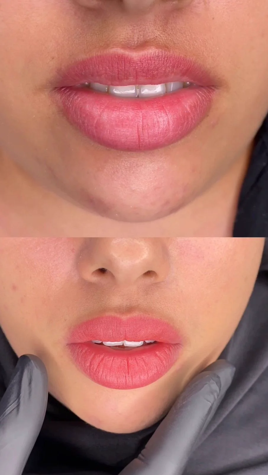 Resultado antes e depois com o protocolo Reabilita Lips — caso 1