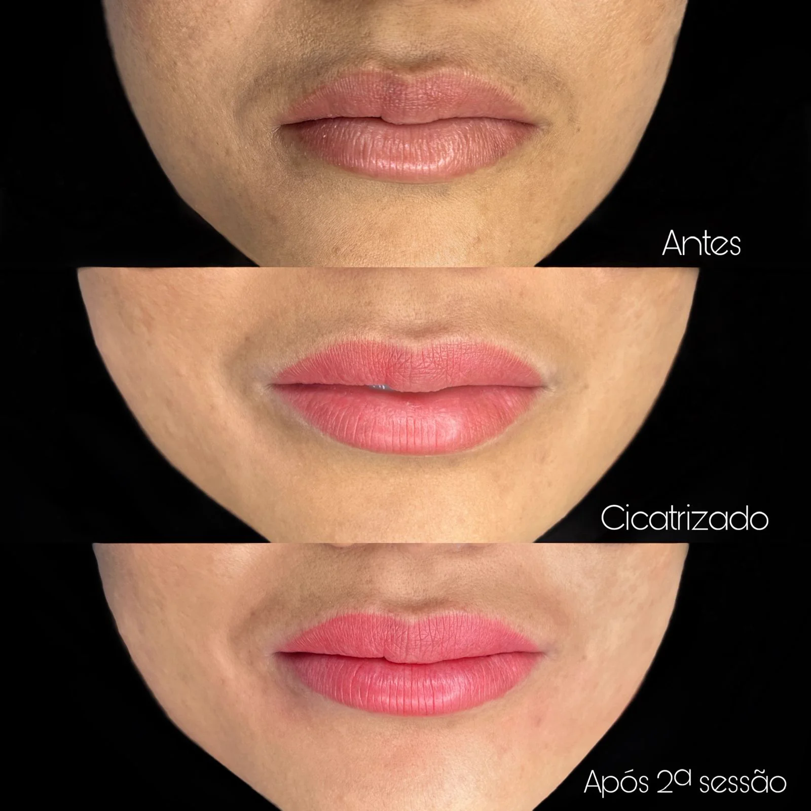 Resultado antes e depois com o protocolo Reabilita Lips — caso 2