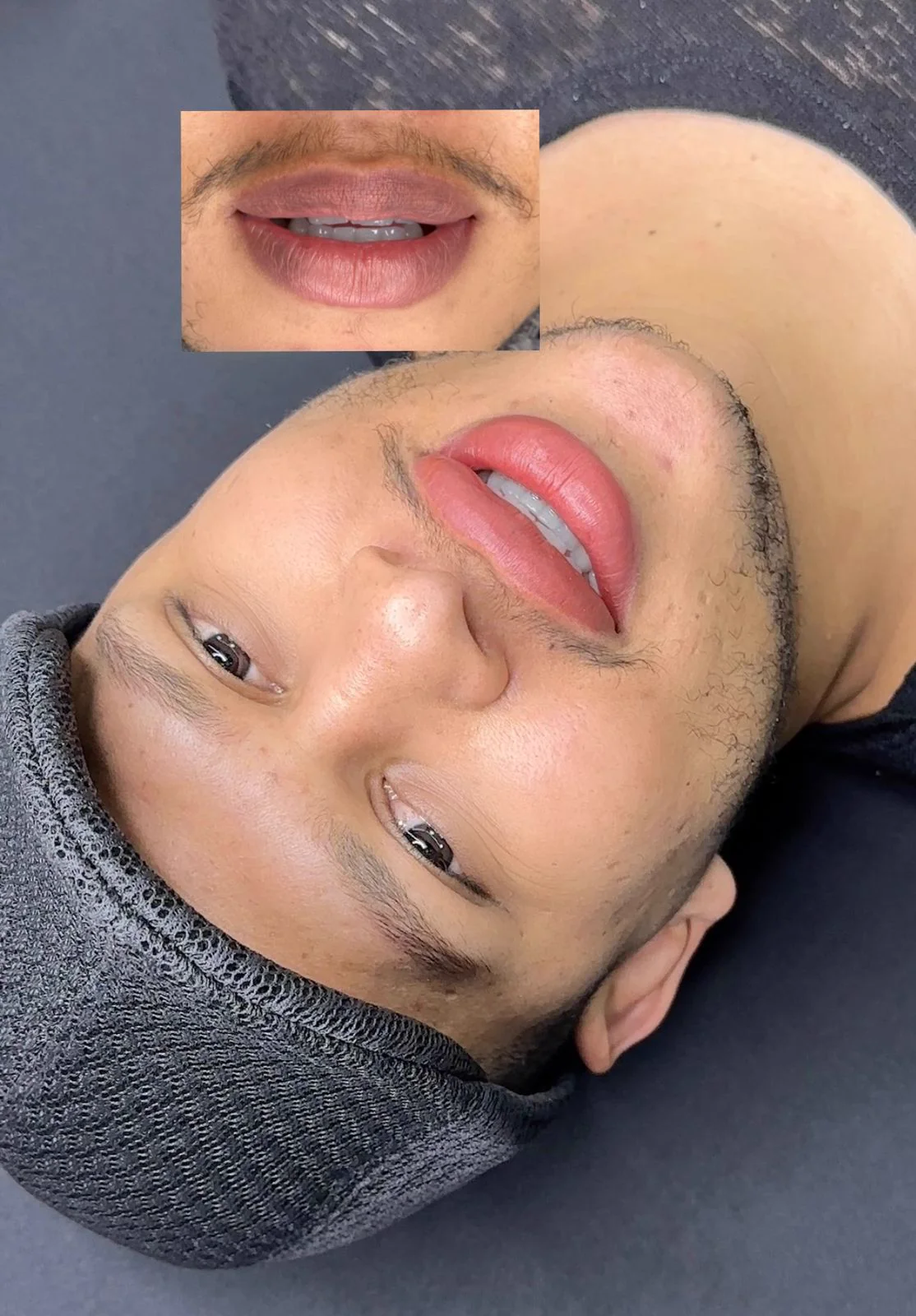Resultado antes e depois com o protocolo Reabilita Lips — caso 3